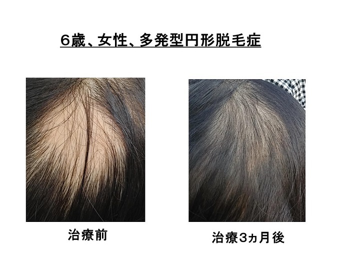 円形脱毛症　病院